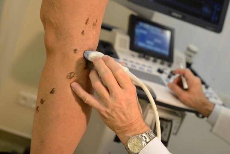 Žilní trombóza: příčiny, prevence a léčba Moderní přístup k léčbě křečových žil: vývoj přináší nové možnosti