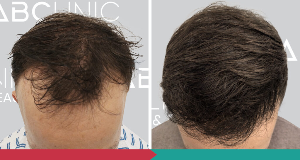 Transplantace vlasů